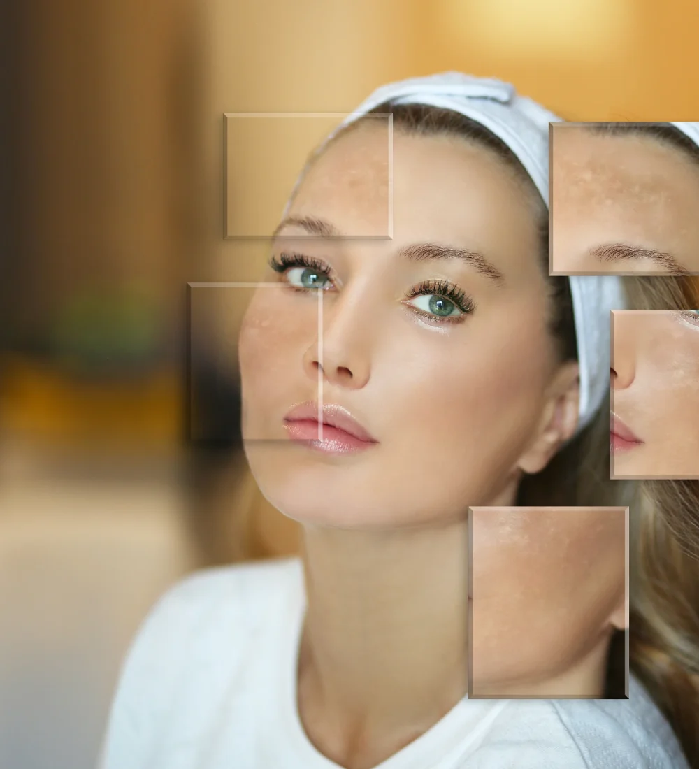hyperpigmentation