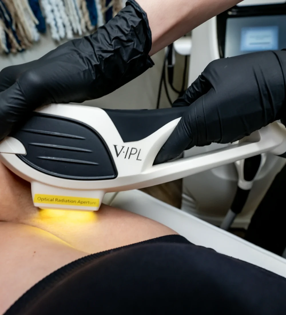 laser hair removal