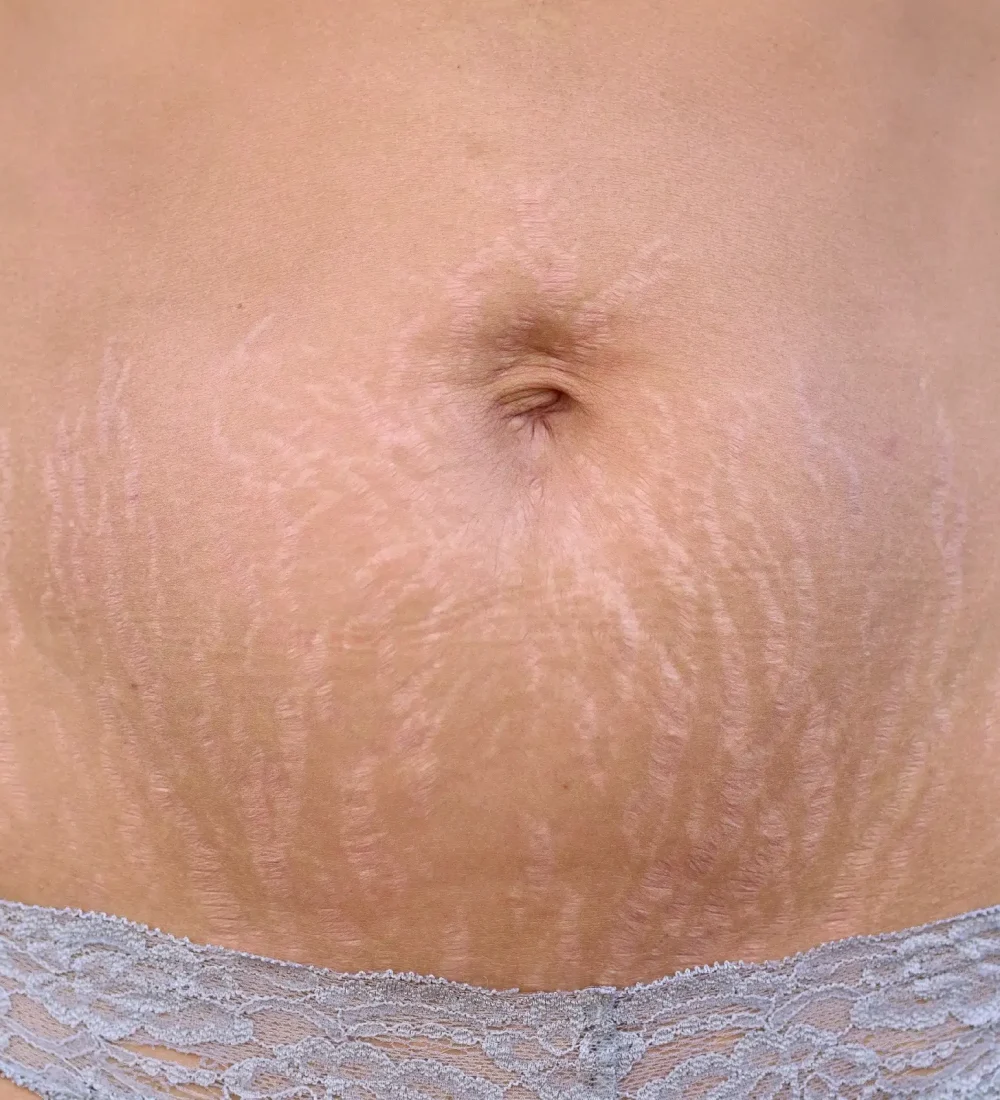 stretch mark reduction